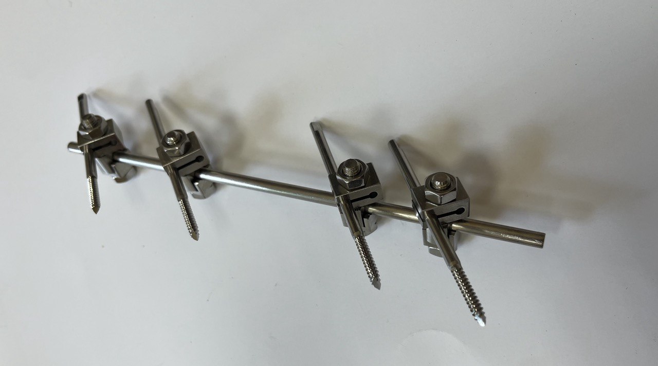 Апарат зовнішньої фіксації на кисть